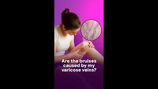 Are the bruises caused by varicose veins?