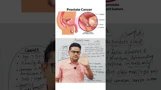Prostate Cancer Overview 🔥