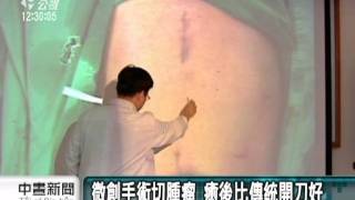 20111103-公視中晝新聞-神奇微創手術 切除三分之二胃一週出院.mpg
