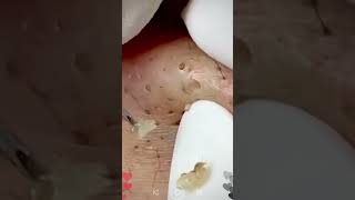 Skincare | Blackheads Removal #463 #tweezers skincare #blackheads blackheads