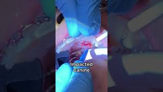 Exposed and Bond procedure - Impacted Canine - Video 6 Tooth Time Family Dentistry New Braunfels TX