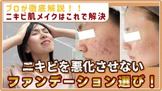【ニキビ肌のメイク】おすすめファンデーションをプロが解説！