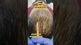 Best Hair Loss Treatments | Hair PRP | #shorts #hair #haircare #prp