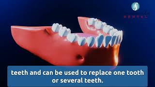 Affordable Dental Implants | Smile World Dental (209) 543-0555
