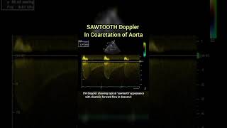Sawtooth Doppler of Coarctation of Aorta on Echocardiography #cardiology