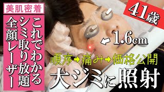 【シミ取り放題完全密着】濃くて大きなシミを消したい！シミ取りレーザーで美肌になるまで【ピコレーザー全顔照射】湘南美容クリニック