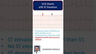 ECG Shorts: aVR ST Elevation