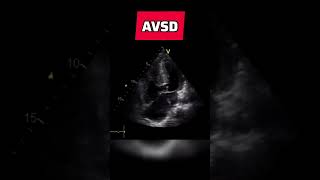 Atrioventricular septal defect - congenital heart defect #echocardiography #AVSD