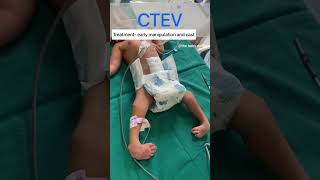 CTEV | congenital talips equino varus | the baby doctor #newborn #shorts #ctev #ytshorts #pediatric