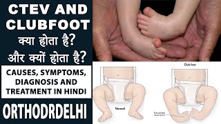 Ctev and clubfoot क्या होता है? और क्यों होता है? | CTEV: Causes, Symptoms, Diagnosis and Treatment