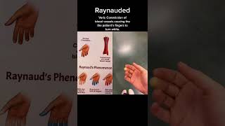 #raynaudssyndrome #raynauds #raynaudsphenomenon #doctor #medicine #medtok #vascular #DIYwithBlock