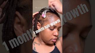 1 month Hair growth journey! #minoxidil #hairgrowth #hairgrowthchallange #baldinghair #hairloss