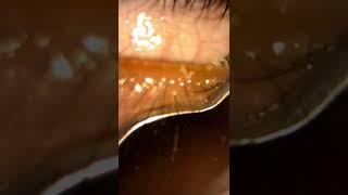 Unblocking oil glands in the eyelid