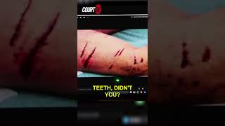 Dog bite expert testified about uncertainty if #JohnOKeefe’s wounds were from a dog’s claws or teeth