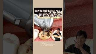 大きな虫歯もなるべく神経を残す!?　#なかの歯科 #岡山歯医者 #根管治療 #虫歯治療