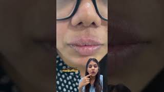 Lip licker’s dermatitis treatment | #liplickersdermatitis #liplicking #shorts #youtubeshorts