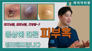 뾰루지? 종기? 염증? 고름? 수술해야 되나요? 피부혹, 종양 (피지낭종, 표피낭종, 지방종, 섬유종, 혈관종)