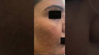 Skin care treatment | Pigmentation Treatment | Face Treatment #shorts #ytshorts #explore #trending