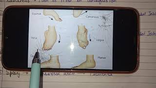 CTEV part-1 Congenital Talipes Equino varus /Club foot
