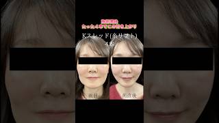 TFCのKスレットならダウンタイム最小限で若返り#美容整形 #糸リフト #アンチエイジング #たるみ #TFC
