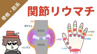 【国試対策】関節リウマチの症状