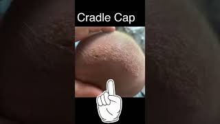 Happy Cappy Shampoo - The Best Solution for Toddler Cradle Cap #shorts