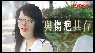 【TOPick健康】8歲火海毀容雙親身亡　堅強女生3年歷40次手術：疤痕是生活一部分