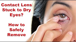 How to Safely Remove Stuck Contact Lens Dried to the Eye