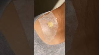 Remove Skin Tag naturally with simple home remedies, read description box #skintags #skintagremoval
