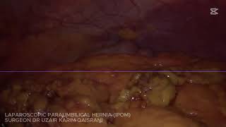 #laparoscopic#paraumbilical #hernia#laparoscopicsurgeon #advance #surgeryeducation