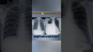 Diffrence between Normal Chest X ray &Pleural effusion #medicalimaging #xray #radiology