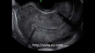 Intrauterine Device on Transvaginal Ultrasound