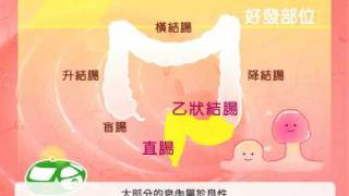 結直腸癌照護網::大腸導覽 03「息肉與憩室」