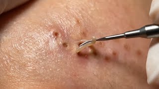 I Can't Believe This Blackhead Removal Method ACTUALLY Works! 🤯✨