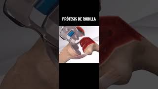 Prótesis de rodilla