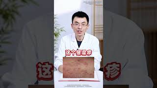 三种皮肤病要分清，否则越治越严重 #湿疹  #红疹  #瘙痒  #抖出健康知识宝藏   #健康科普有真知