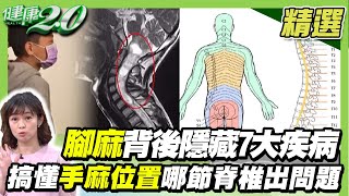搞懂手麻位置哪節脊椎出問題！腳麻背後隱藏7大疾病！腫瘤長在頭頸最凶險！【健康2.0精選】