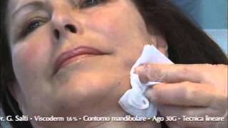 Aplicación VISCODERM 1.6% en Contorno Mandibular. Dr. Giovanni Salti