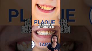 牙菌斑和牙結石的差別#一天刷幾次牙#洗牙