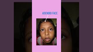 Answer of image 3 of Guess the image #tooth #neetmdslectures #exam #dentalexam