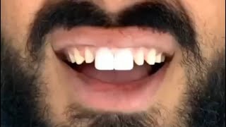 CHANGING MY CROWNS IN TURKEY #veneers #teeth #dentist #dentalcentreturkey  #turkey #whiteteeth