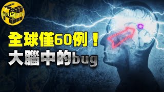 全球僅有60例！這種罕見疾病能開啟大腦無限潛能，患上的人卻無比痛苦...[腦洞烏托邦 | 小烏 | Xiaowu]