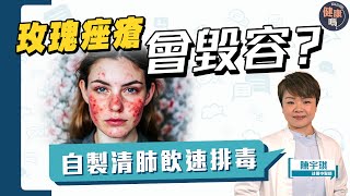 以為面紅只是皮膚敏感？忽視玫瑰痤瘡恐毀容｜女士最高危 情緒壓力引爆玫瑰痤瘡｜玫瑰痤瘡關肺事？中醫師教你自製枇杷清肺飲排毒｜健康嗎@HealthCodeHK 【Chat醫D】#玫瑰痤瘡 #皮膚病