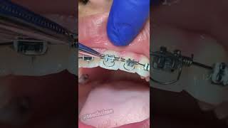 Torque Springs Orthodontics - Braces On - Tooth Time Family Dentistry New Braunfels