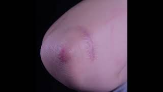 蟹足腫治療！跟醜醜的蟹足腫疤痕說掰掰！#shorts