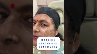 Filler for sunken eyes #undereyedarkcircles #undereyefiller #assamfashion #fillersinjection
