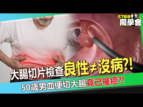 大腸檢查良性≠沒病？！50歲男血便頭暈「腸道潰瘍還變大」...切掉後傻眼：癌症第一期！【@57healthy 】#陳榮堅 醫師