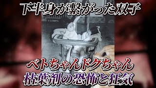 元結合双生児・ベトちゃん・ドクちゃん　枯葉剤の恐怖と狂気