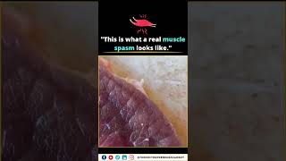 What Is a Muscle Spasm? Causes, Symptoms & Quick Relief 💥🩺