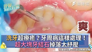 洗牙超療癒？牙周病這樣處理！超大塊牙結石掉落太紓壓